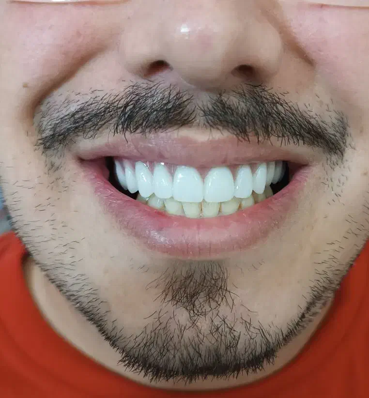 پروتز دندان (دندان مصنوعی)|خدمات آرایشگری و زیبایی|تربت‌حیدریه, بازار|دیوار