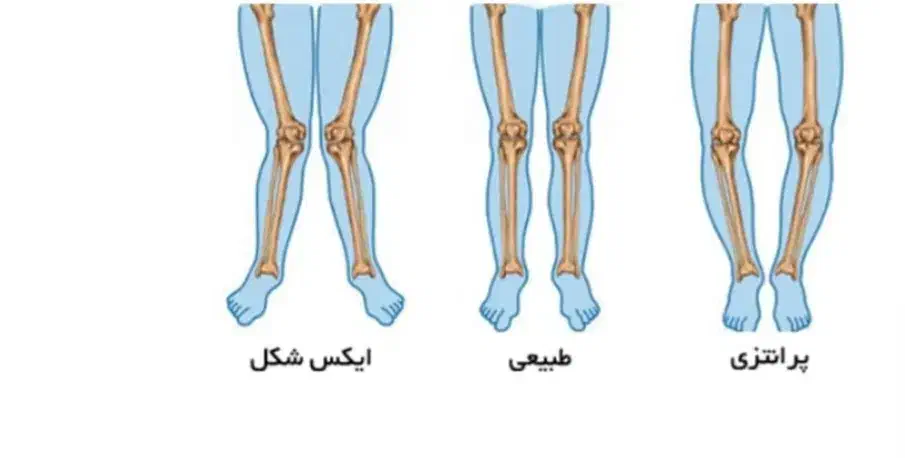 مرکز تخصصی اصلاح غیرجراحی انحرافات زانو|خدمات آرایشگری و زیبایی|بهار, |دیوار