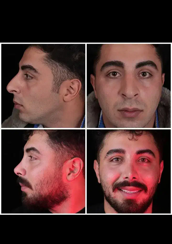 عمل جراحی بینی فقط 28.900 درکرج بدون تامپون(ENT)|خدمات آرایشگری و زیبایی|کرج, جهان‌شهر|دیوار