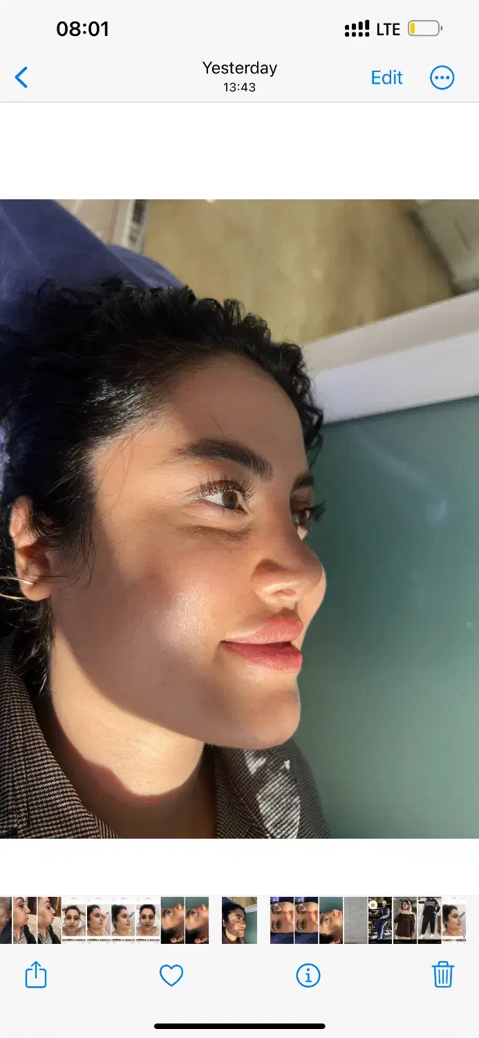 تزریق چربی به تمام نواحی|خدمات آرایشگری و زیبایی|قزوین, |دیوار