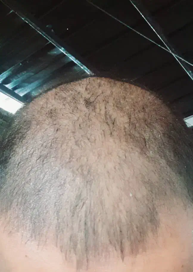 درمان قطعی ریزش مو و رویش مجدد|آرایشی، بهداشتی، درمانی|تهران, چیتگر شمالی|دیوار