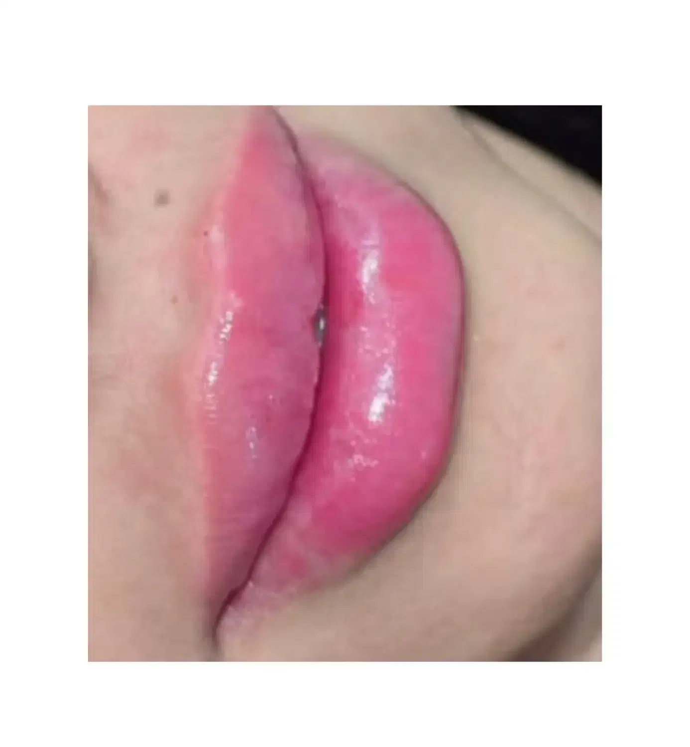 فیلر‌‌ صورت /  ژل صورت|خدمات آرایشگری و زیبایی|فولادشهر, B2|دیوار