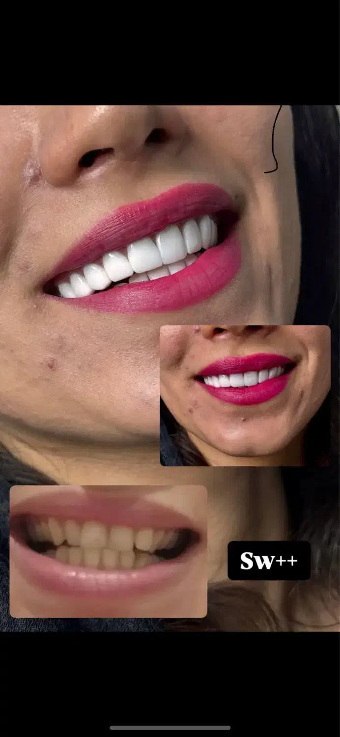 کامپوزیت دندان اقساطی بدون بهره|خدمات آرایشگری و زیبایی|اصفهان, عسگریه|دیوار