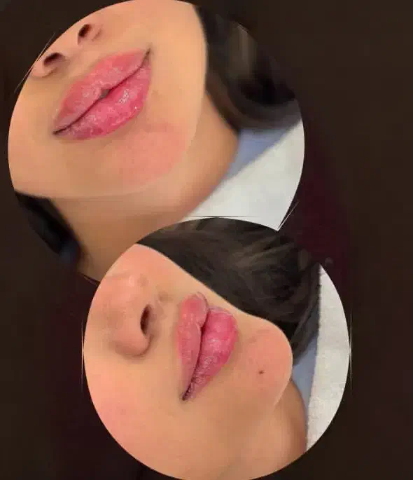 تخفیف تزریق ژل وبوتاکس|خدمات آرایشگری و زیبایی|آمل, |دیوار