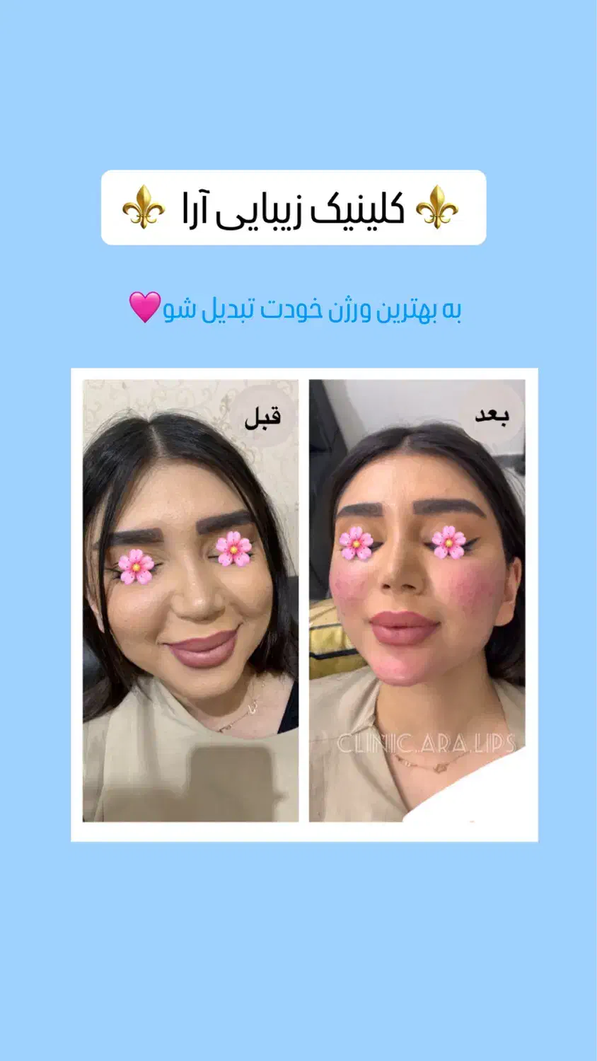 ژل/بوتاکس/مزو ژل/وآموزش|خدمات آرایشگری و زیبایی|خرمشهر, |دیوار