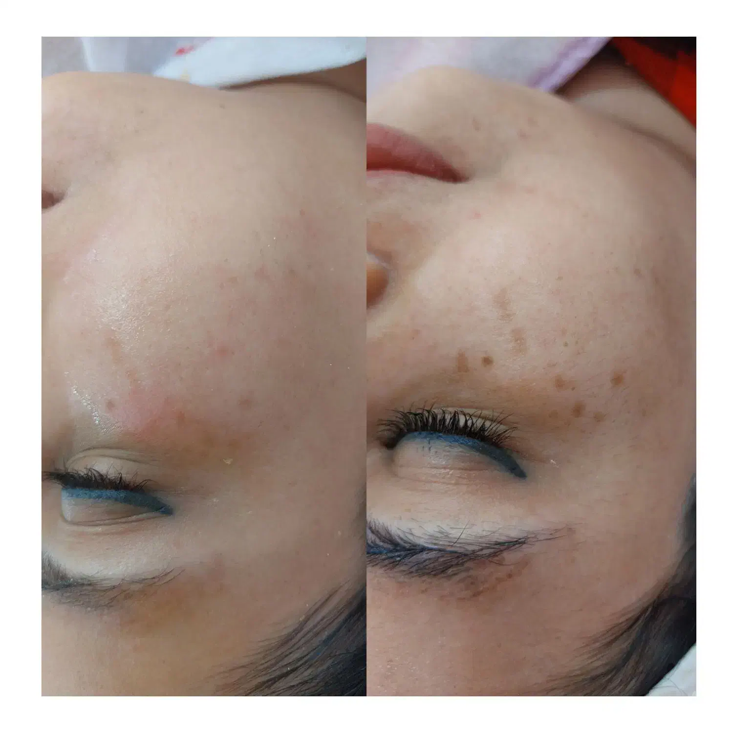 فیشال تخصصی پوست|خدمات آرایشگری و زیبایی|محمدشهر, محمدشهر|دیوار