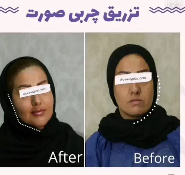تخفیف ساکشن شکم پهلو و پشت/ هر ناحیه از بدن/بلفارو|خدمات آرایشگری و زیبایی|قم, زنبیل آباد|دیوار
