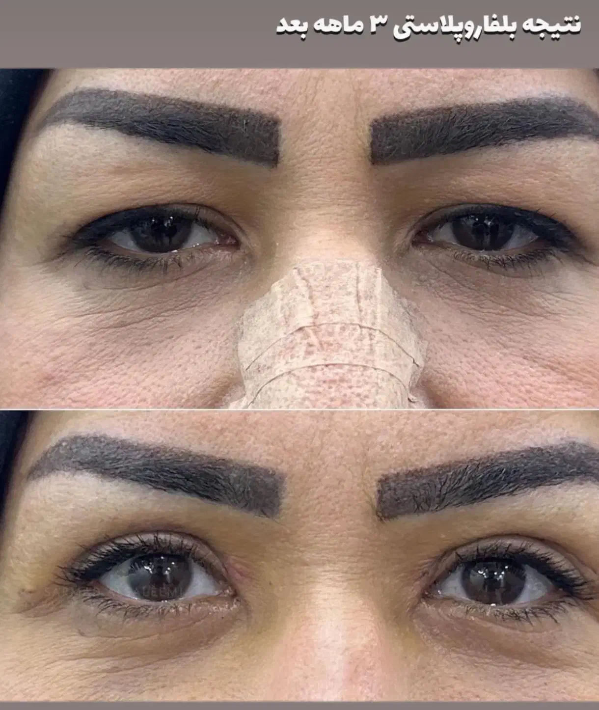 جشنوراه جراحی پلک بالا بلفاروپلاستی|خدمات آرایشگری و زیبایی|اصفهان, خانه اصفهان|دیوار