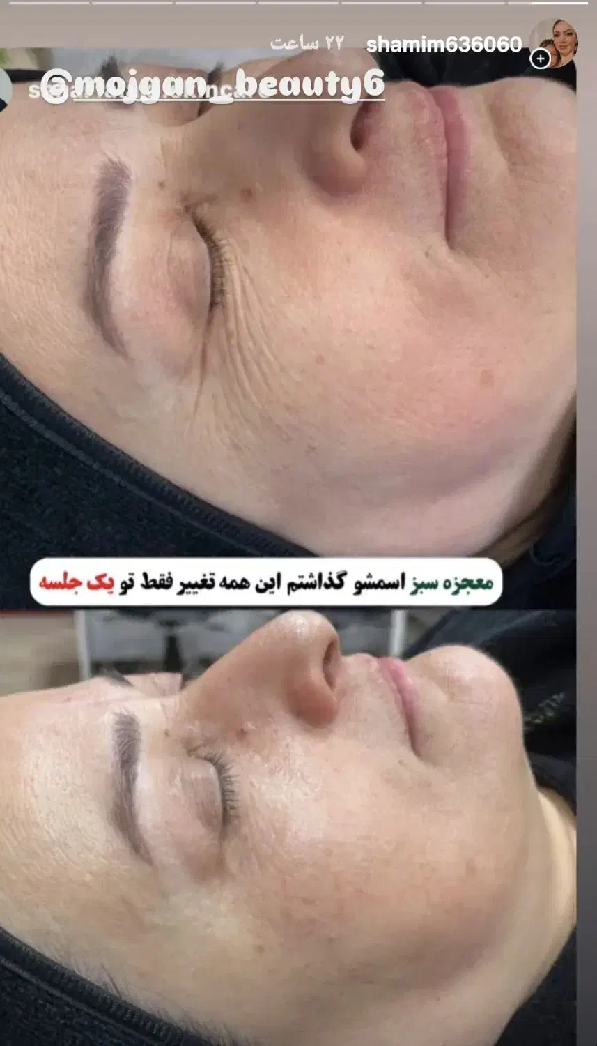 اموزش وخدمات تخصصی پوست باتخفیف بلک فرایدی|خدمات آرایشگری و زیبایی|تربت جام, تیپ ۳۸ زرهی تربت جام|دیوار