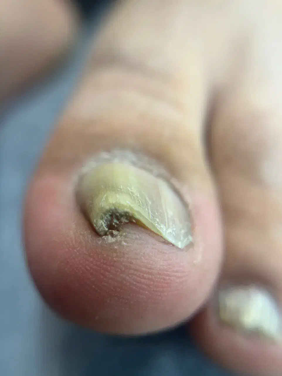 فرورفتگی ناخن توگوشت|آرایشی، بهداشتی، درمانی|انار, |دیوار