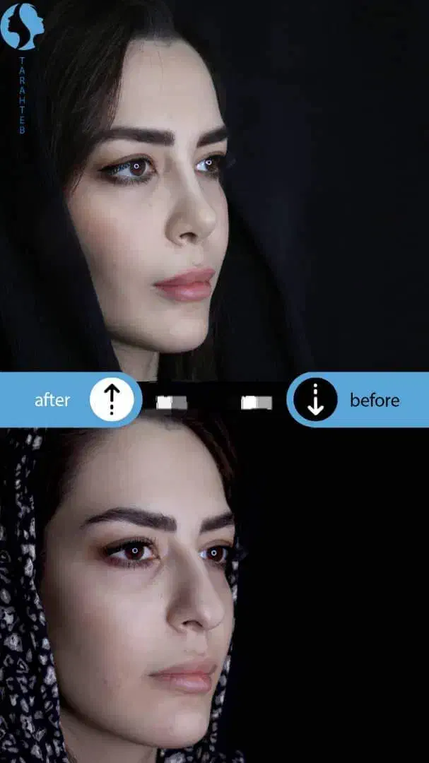 عمل بینی با قالبهای کنترلی|خدمات آرایشگری و زیبایی|تهران, امانیه|دیوار