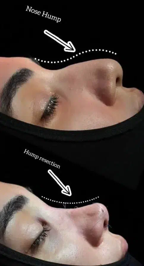 عمل بینی|خدمات آرایشگری و زیبایی|کرج, عظیمیه|دیوار