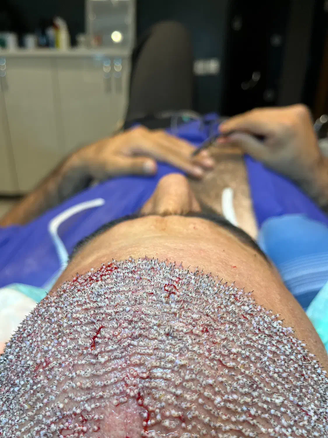 کاشت مو تضمینی با روش fit|خدمات آرایشگری و زیبایی|تبریز, |دیوار