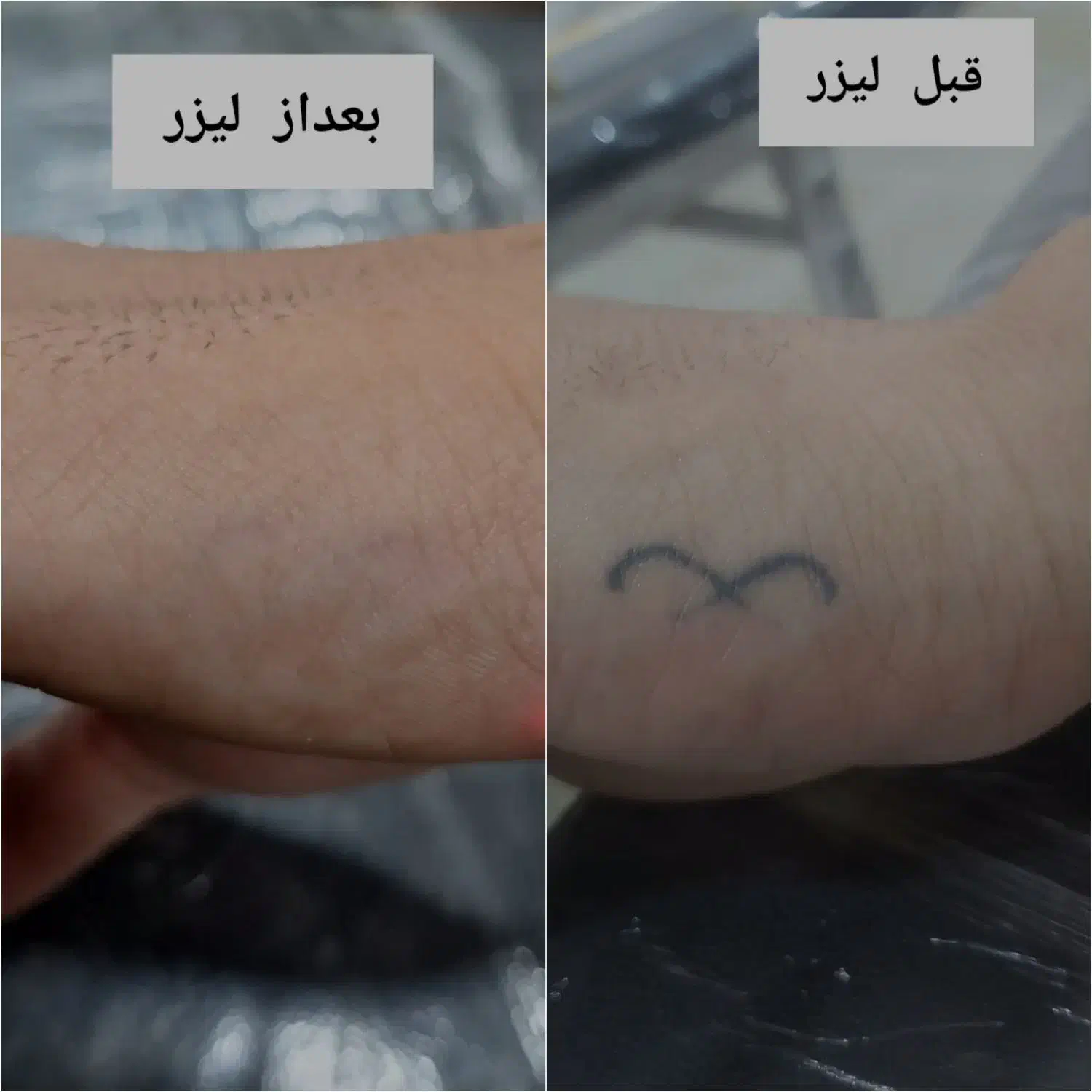 پاک کردن تاتو با دستگاه لیزر پیشرفته|خدمات آرایشگری و زیبایی|ماهدشت, |دیوار