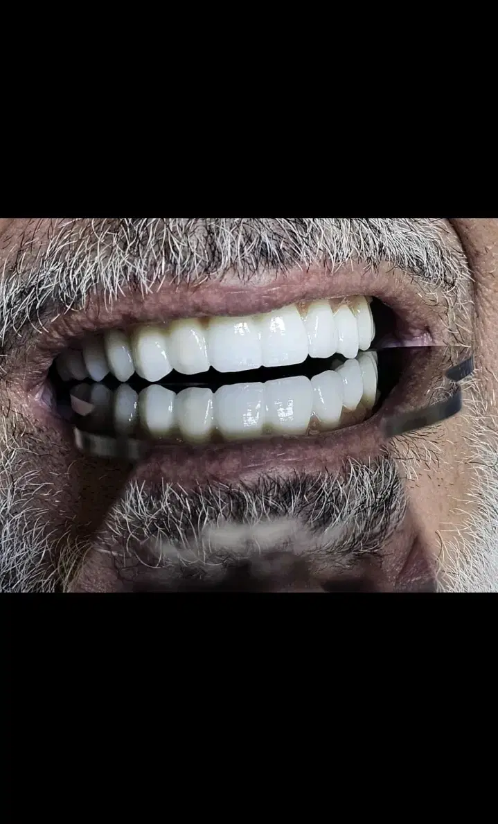 جشنواره ایمپلنت کره ای 11/400 ،ایرانی 8500|خدمات زیبایی و سلامت|تهران, شهرآرا|دیوار