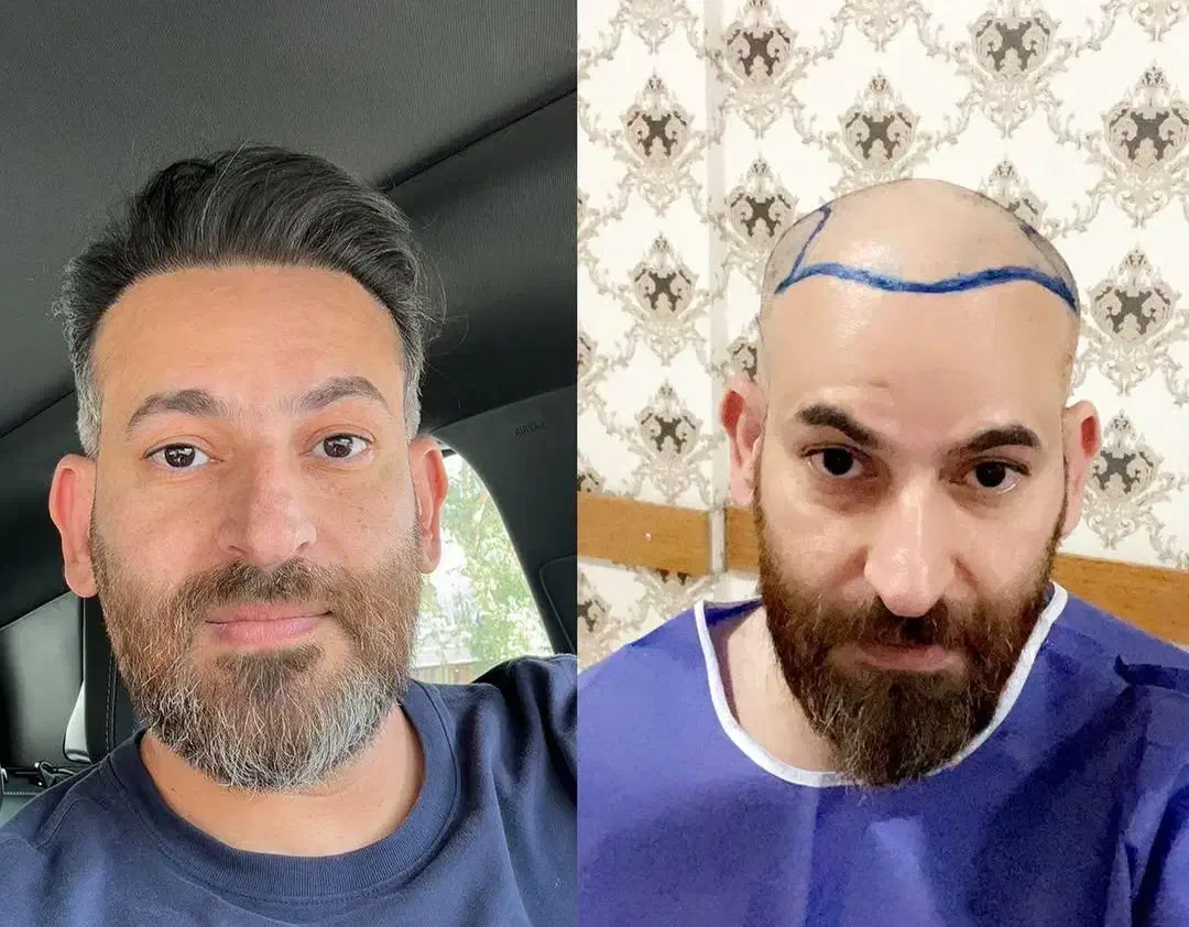 کاشت مو،کاشت ابرو، کاشت ریش، بلفاروپلاستی|خدمات آرایشگری و زیبایی|مشهد, کلاهدوز|دیوار