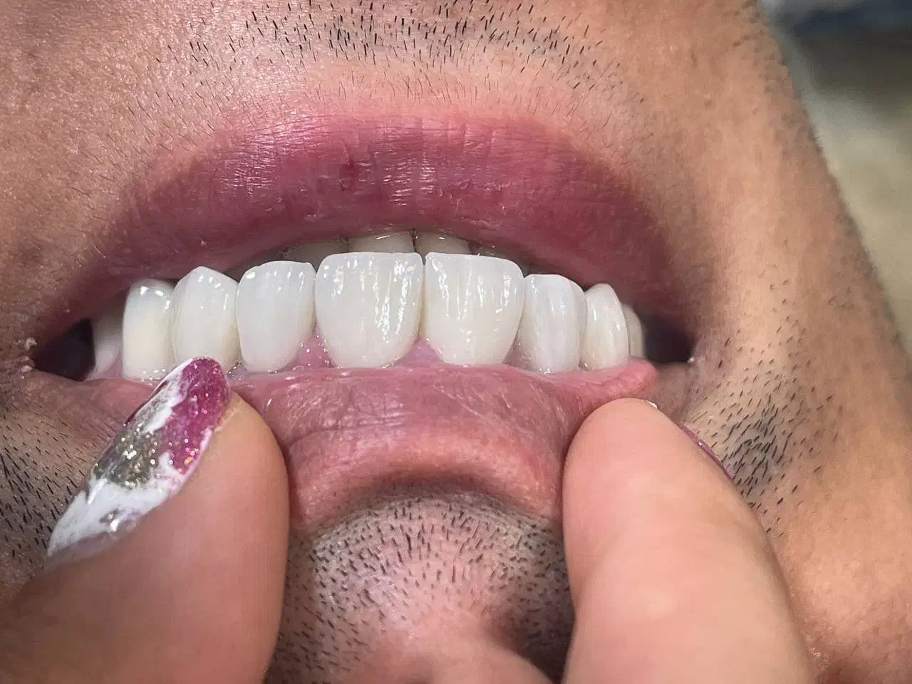 جشنواره کامپوزیت،لمینیت وبلیچینگ وخدمات دندانپزشکی|خدمات آرایشگری و زیبایی|شاهین‌شهر, مخابرات (شهید بهشتی)|دیوار