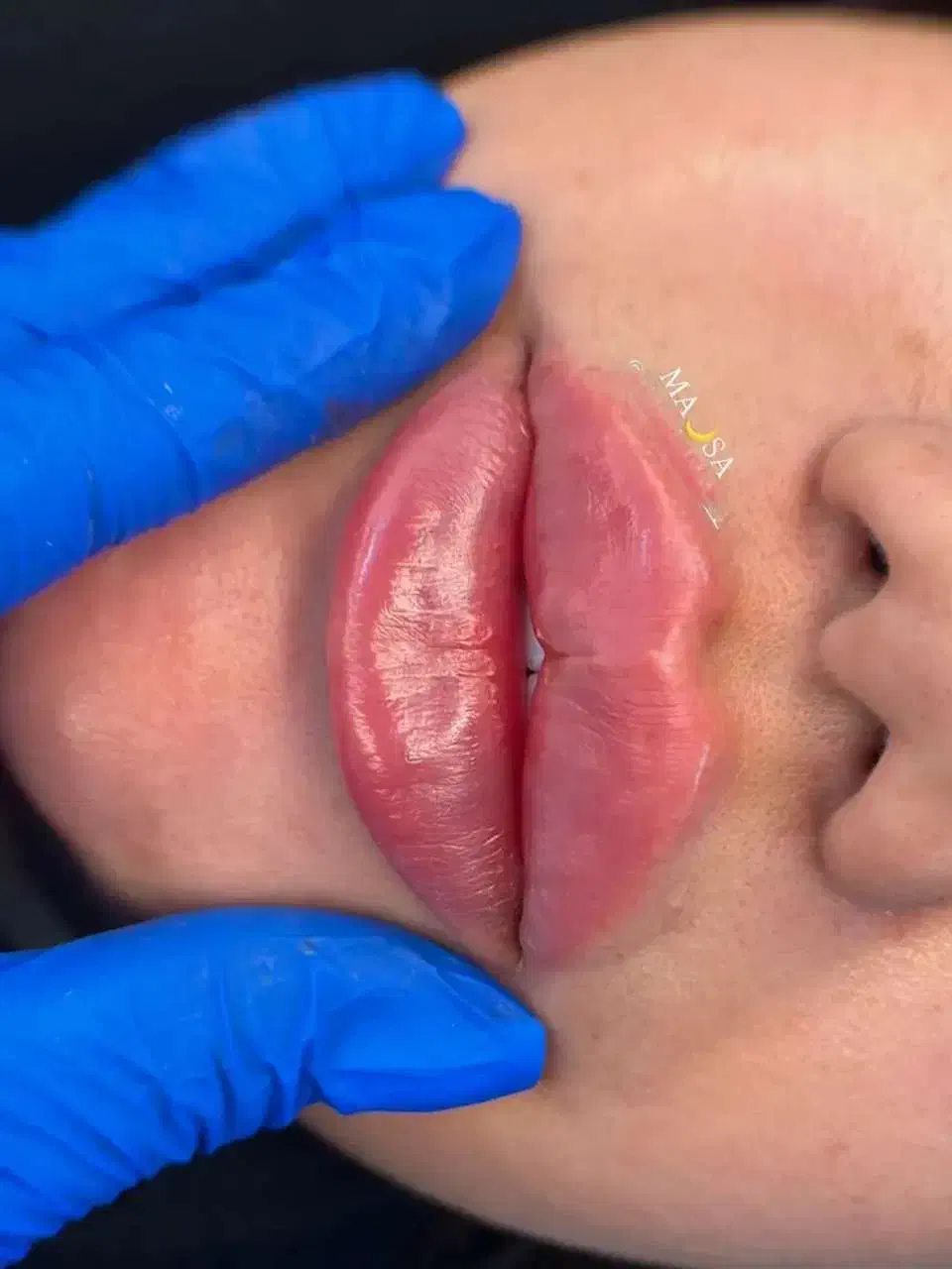 تزریق ژل و بوتاکس تضمینی|خدمات آرایشگری و زیبایی|قرچک, مهدیه|دیوار