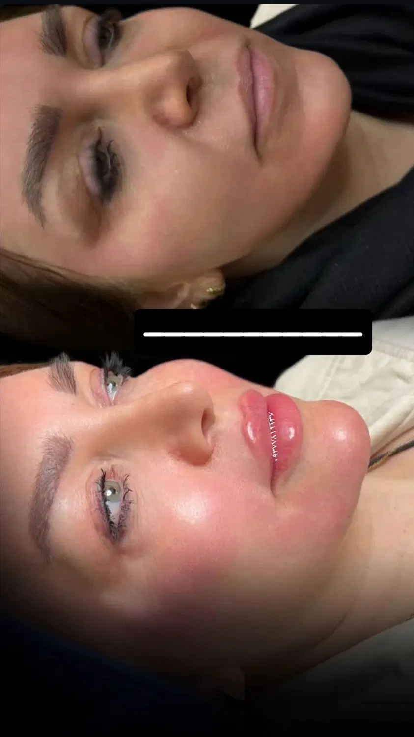 تخفیفات ویژه ژل و بوتاکس ورفع کک و مک ومزو وprp|خدمات زیبایی و سلامت|شیراز, مبعث|دیوار