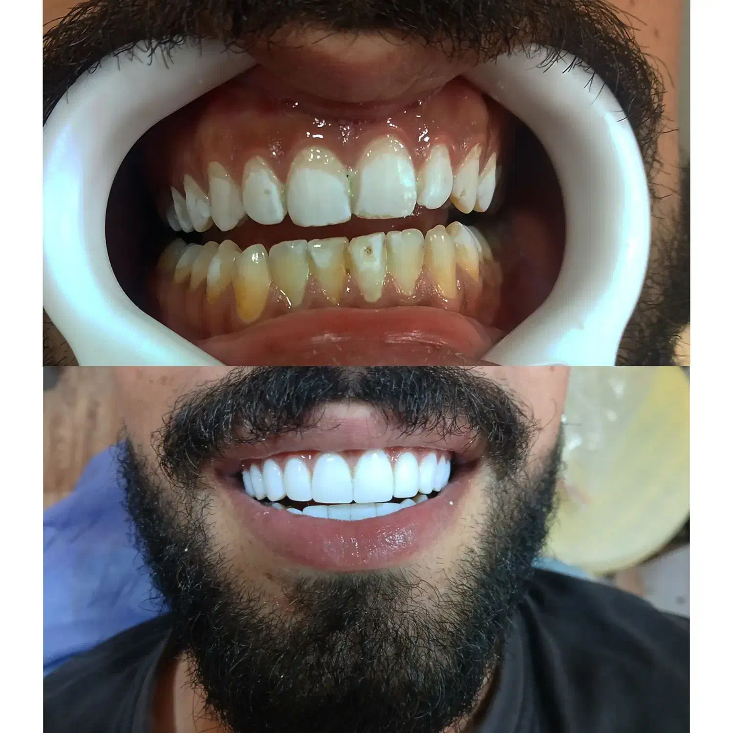 انجام کامپوزیت ونیر با بهترین متریال با افر ۶۰٪|خدمات آرایشگری و زیبایی|بابل, |دیوار