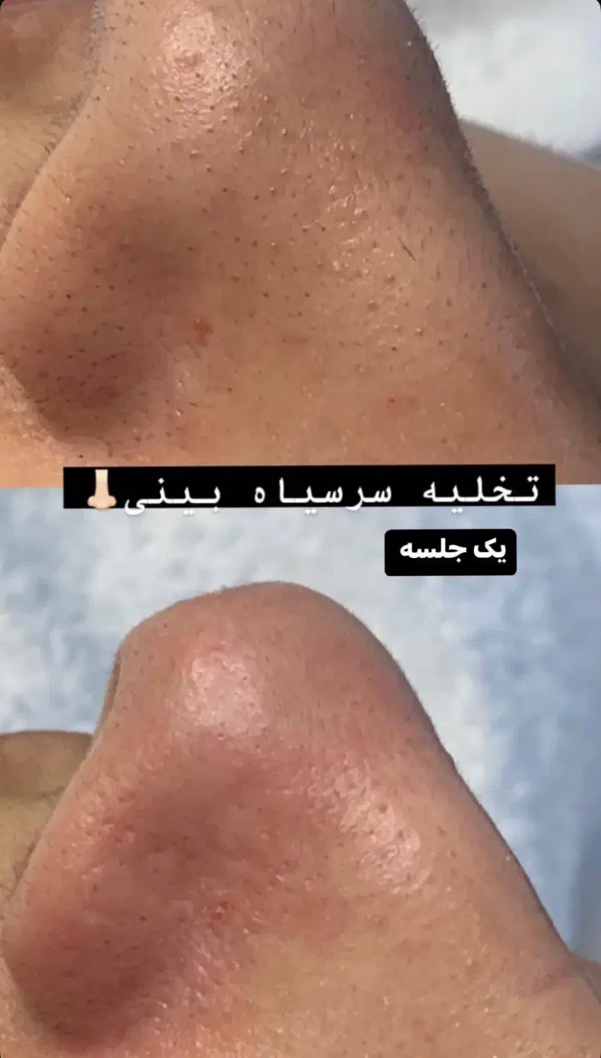 پاکسازی صورت ۲۵۰ تومن|خدمات آرایشگری و زیبایی|لاهیجان, کوی استادان|دیوار