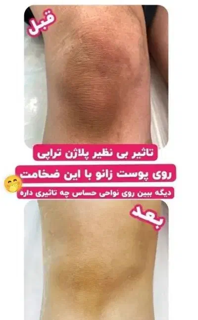 پلاژن روشن سازی|آرایشی، بهداشتی، درمانی|شیراز, معالیآباد|دیوار