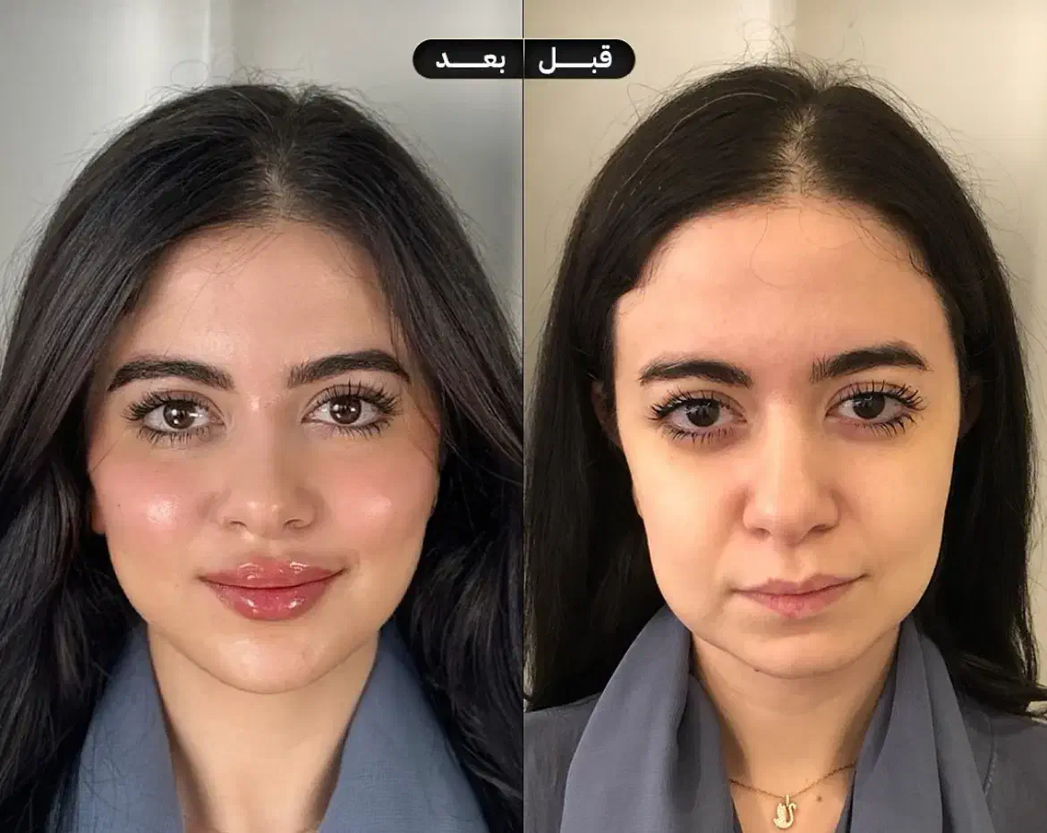 جشنواره ژل لب گونه چونه زاویه فک فیلرزیرچشم بوتاکس|خدمات آرایشگری و زیبایی|تهران, قلهک|دیوار