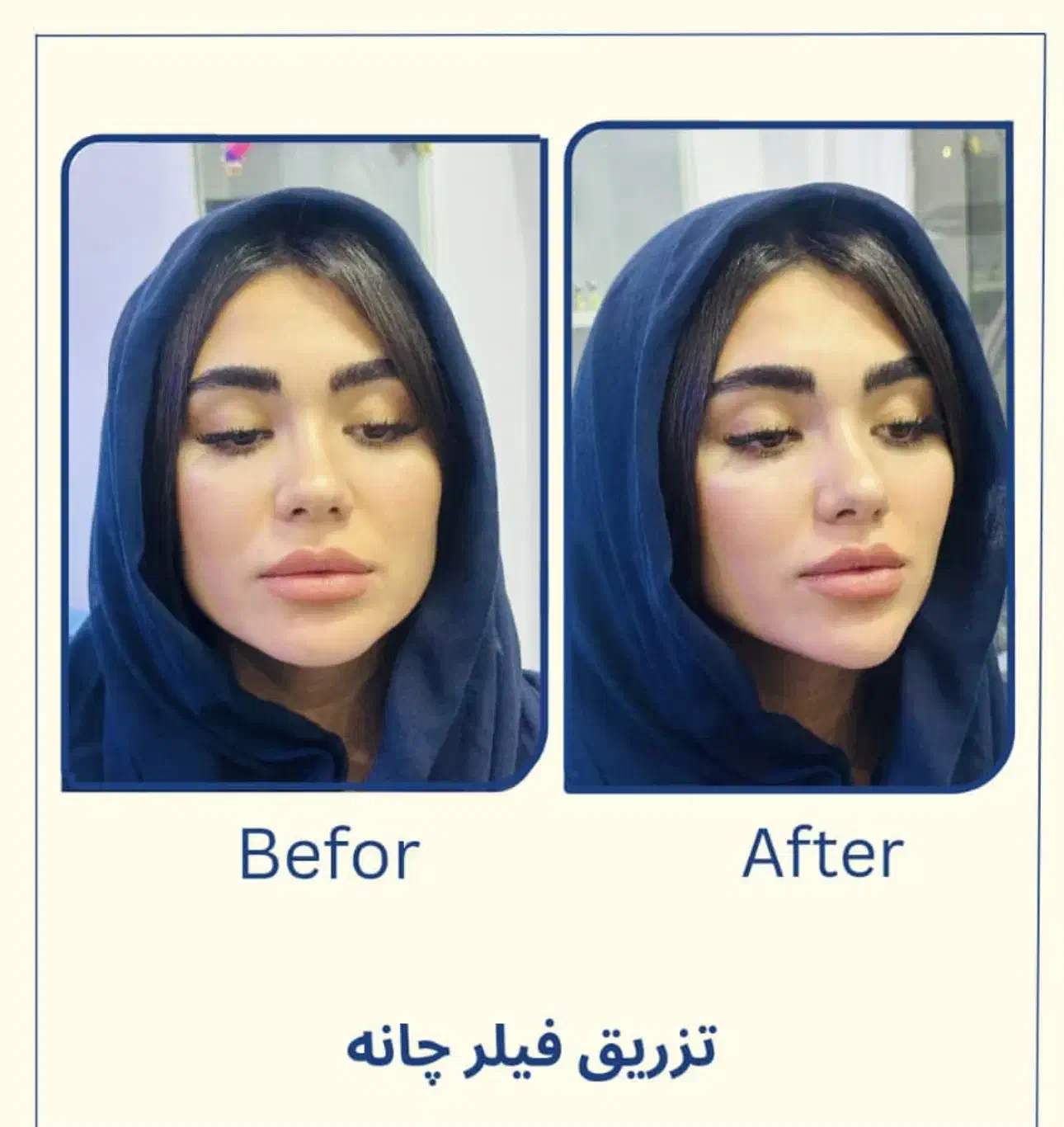 فیلر لب روسی -زاویه سازی -بوتاکس-پی ار پی -مزو|خدمات آرایشگری و زیبایی|تهران, دریا|دیوار