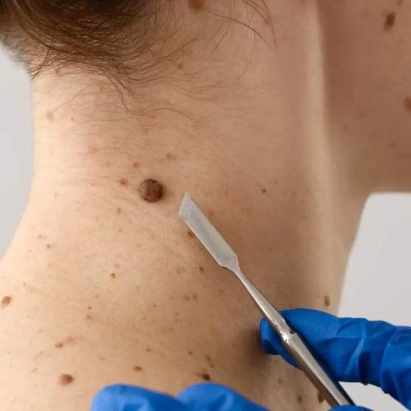 محلول درمان زگیل و زگیل تناسلی|آرایشی، بهداشتی، درمانی|میناب, |دیوار