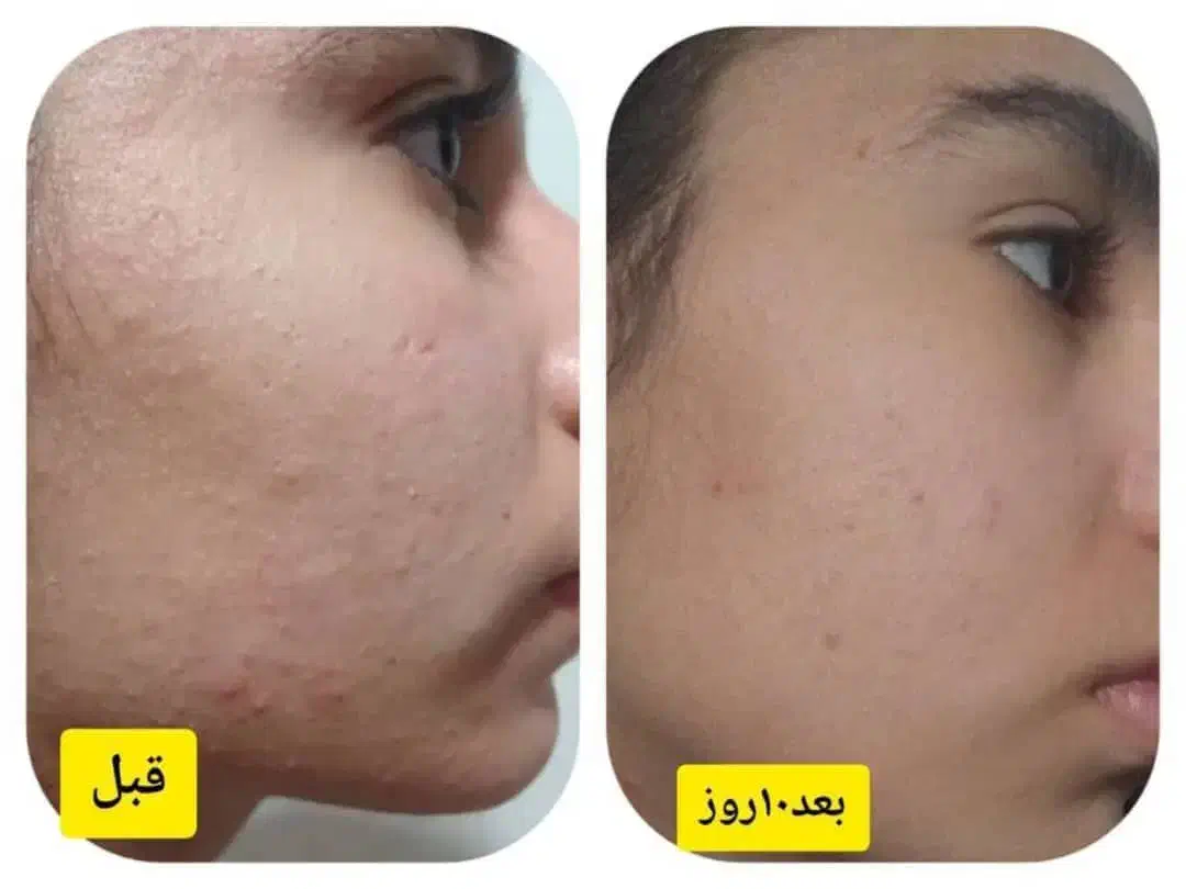 مشاوره رایکان پوست و مو ،درمان لک و ...|آرایشی، بهداشتی، درمانی|رشت, دروازه لاکان|دیوار