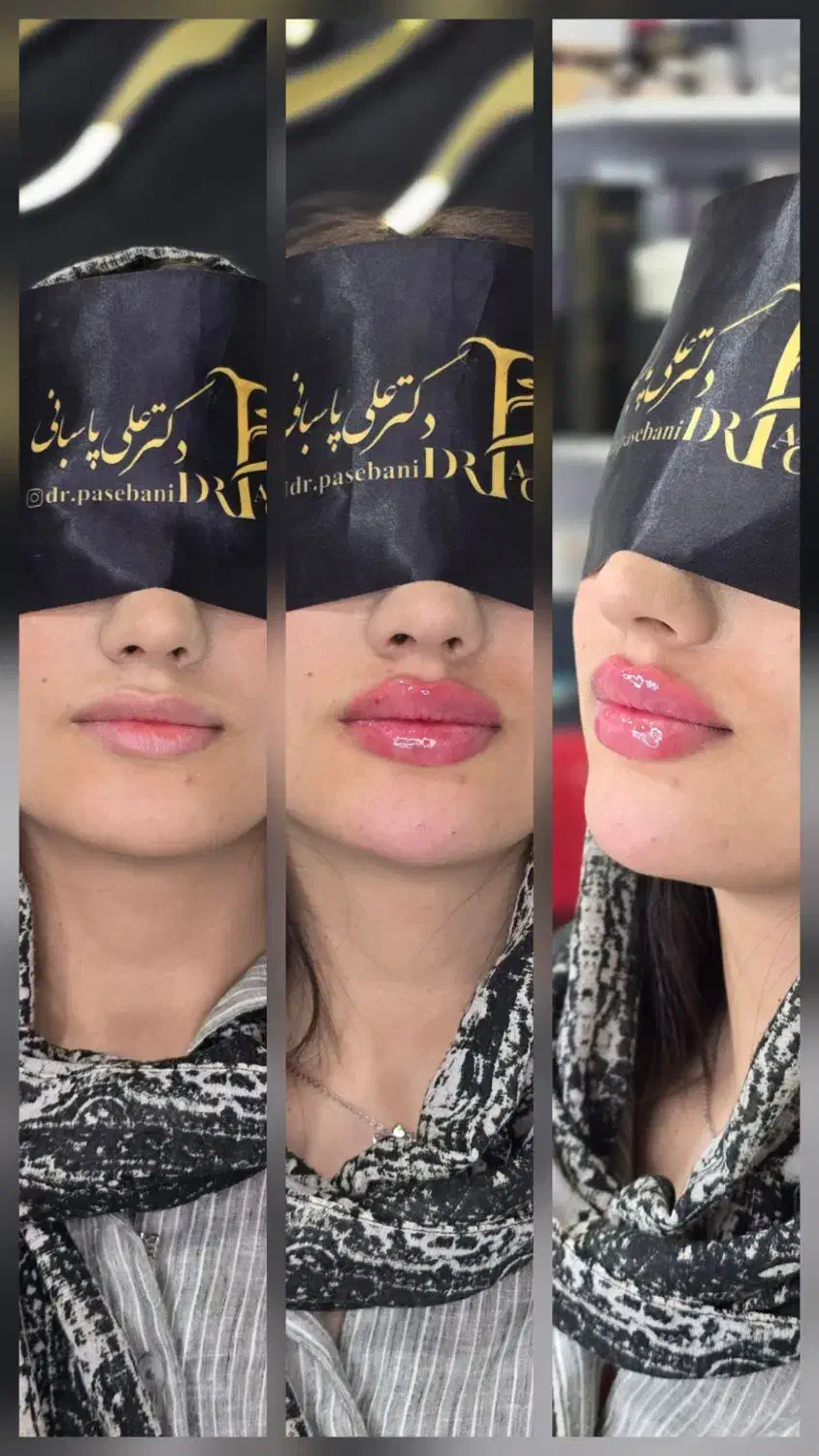 تزریق ژل وبوتاکس و لیزر موی زایدولیزر پاک کردن تتو|خدمات آرایشگری و زیبایی|نسیمشهر, |دیوار