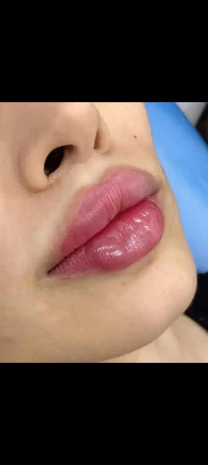 خدمات زیبای فیلر و بوتاکس|خدمات آرایشگری و زیبایی|اسلامشهر, شهرک مصطفی خمینی|دیوار