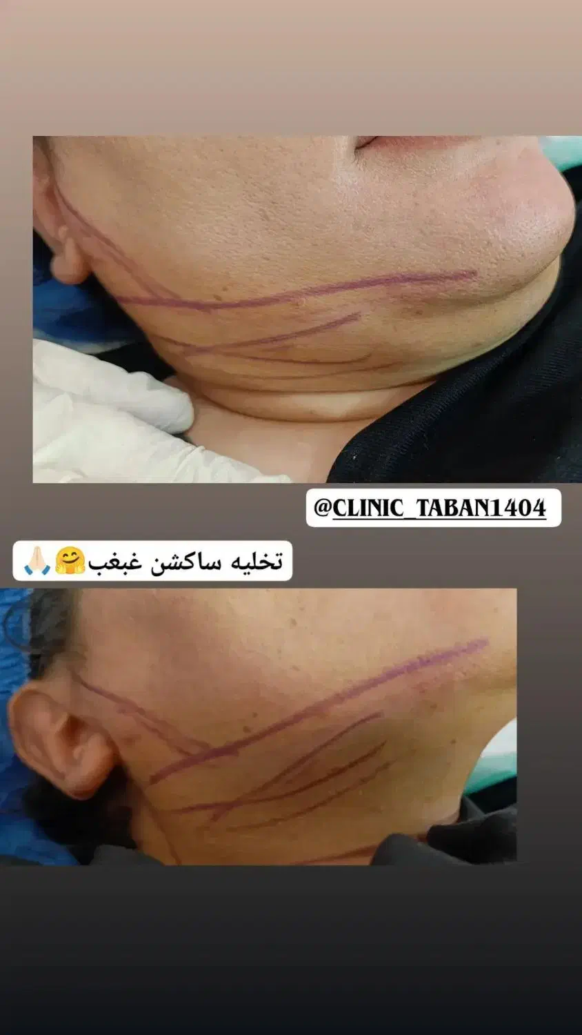 ساکشن وجراحی غبغب|خدمات آرایشگری و زیبایی|کوهدشت, |دیوار