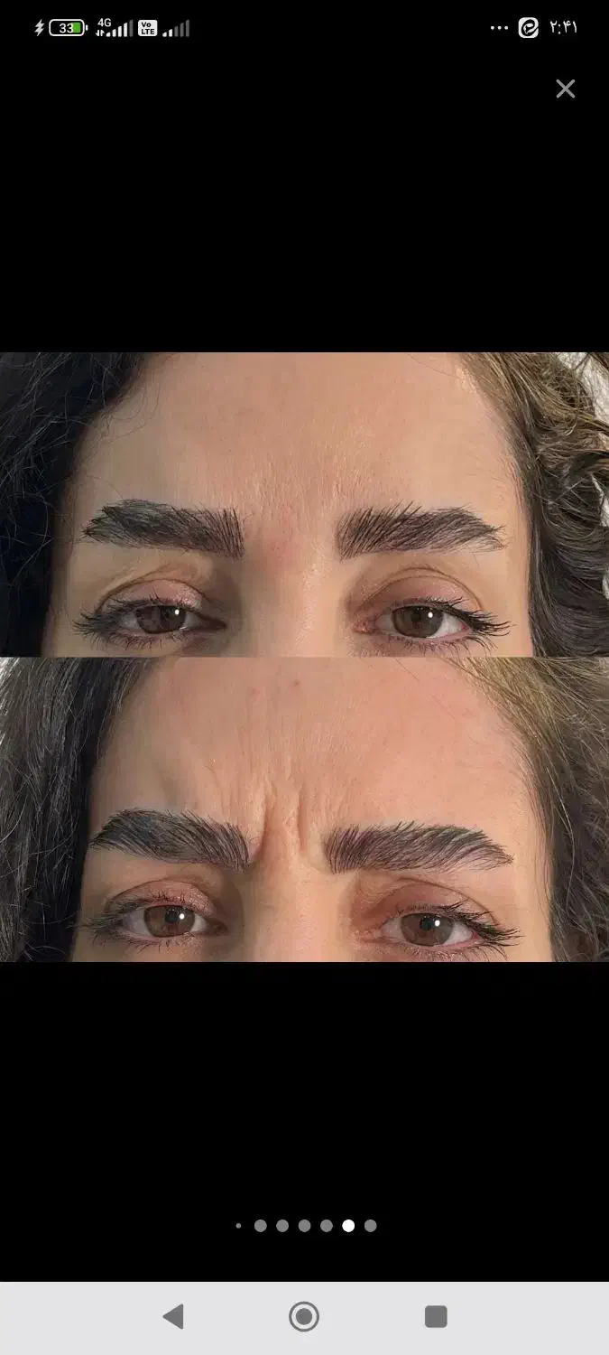 تزریق بوتاکس وژل فقط قیمت مواد|خدمات آرایشگری و زیبایی|اهواز, ۲۴ متری|دیوار