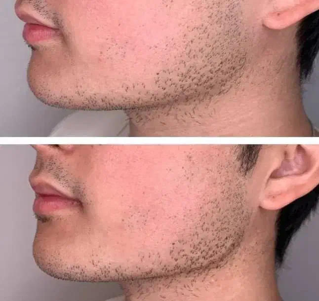 ژل فیلر بوتاکس مزو هایفو لیزر نخ|خدمات آرایشگری و زیبایی|اسلام‌شهر, باغ فیض|دیوار