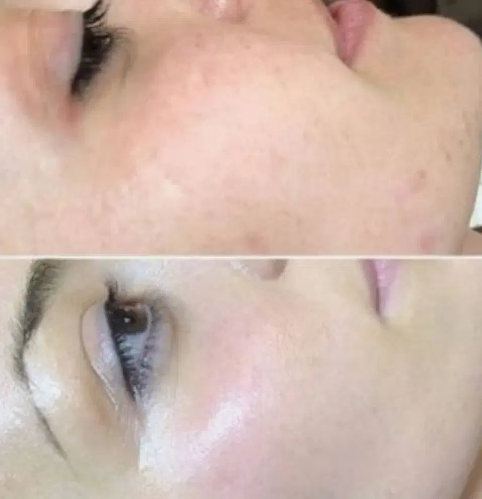 آموزش فیشیال تخصصی. مزو جوانساز صورت|خدمات آموزشی|کوهدشت, |دیوار