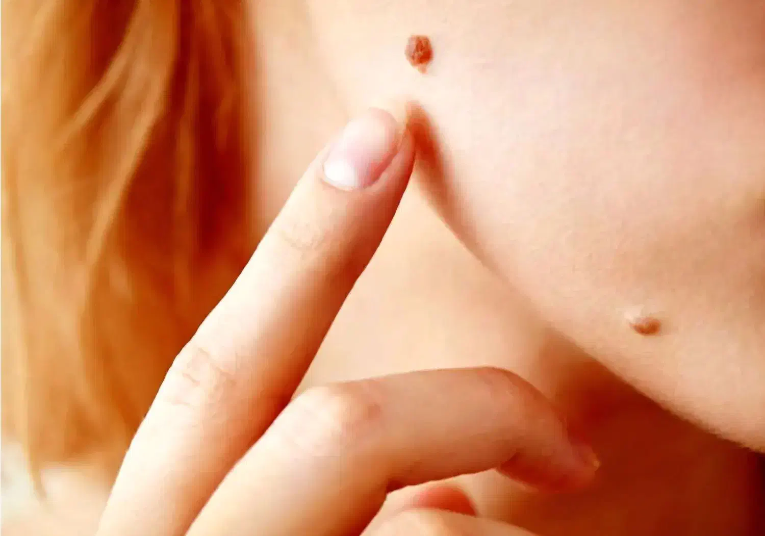 خدمات پلکسر از بین بردن خال وزیگیل|خدمات آرایشگری و زیبایی|پاکدشت, پاکدشت (مامازند)|دیوار