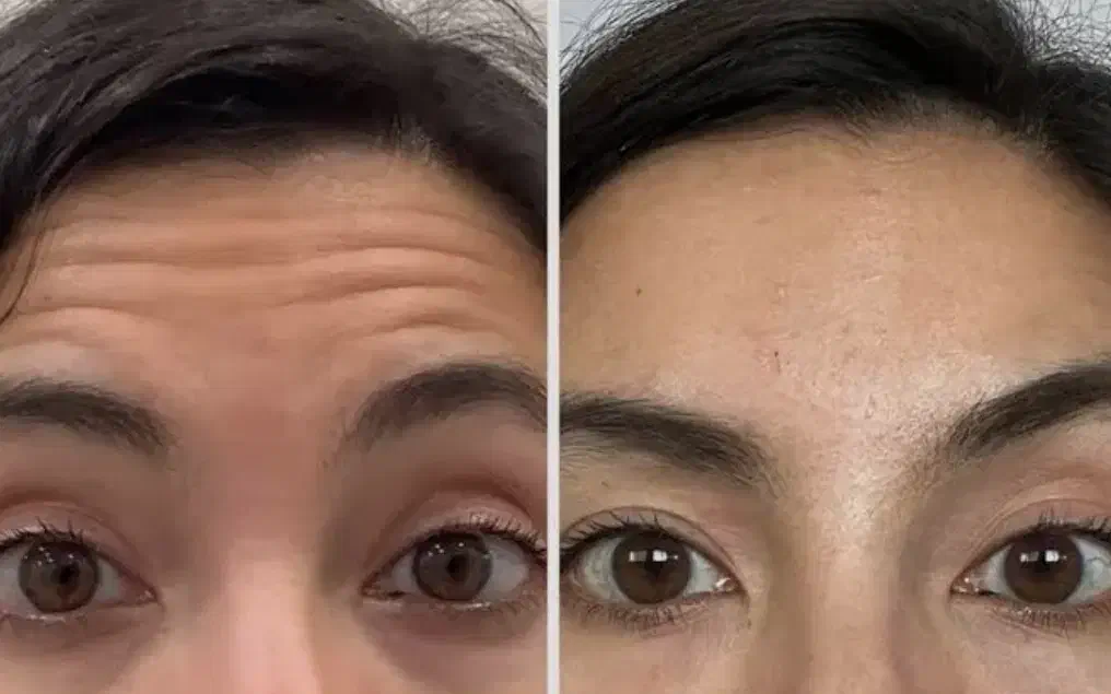 خدمات جوانسازی با بوتاکس|خدمات آرایشگری و زیبایی|چمستان, |دیوار