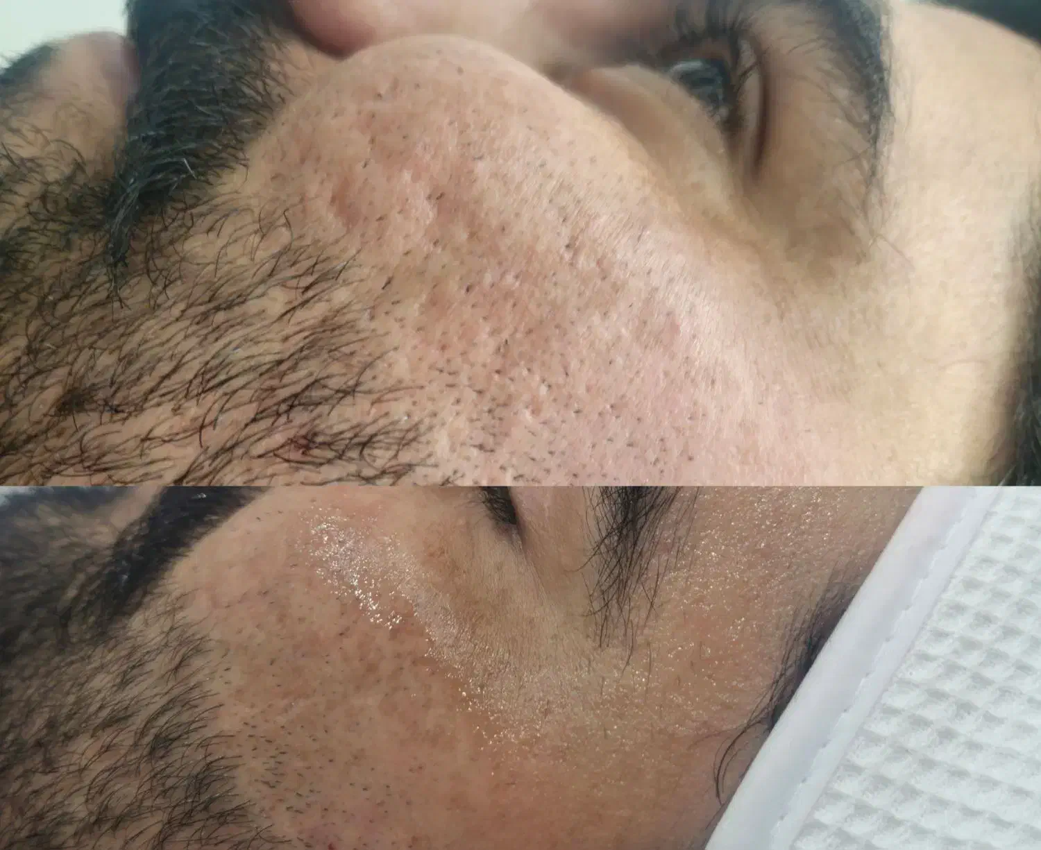 با فیشال تخصصی کلینیک لک و جوش خود را از بین ببر|خدمات آرایشگری و زیبایی|بندرعباس, |دیوار