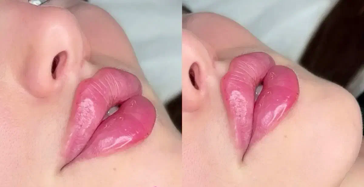 ژل لب گونه چانه،فول فیس لیفت نخ/لیزرآنزیم بوتاکس|خدمات آرایشگری و زیبایی|مشهد, هفت تیر (آب و برق)|دیوار