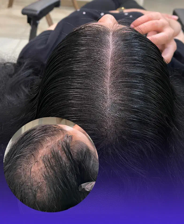 میکرواسکالپ اسکراپ کاشتمو درمجموعه زیبانو|خدمات آرایشگری و زیبایی|مشهد, گوهرشاد|دیوار