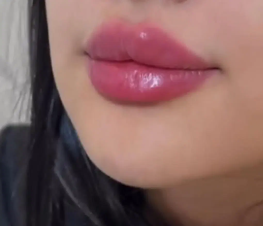 تزریق ژل و آنزیم غبغب وبینی وتزریق آنزیم تخلیه ژل|خدمات آرایشگری و زیبایی|اردبیل, |دیوار