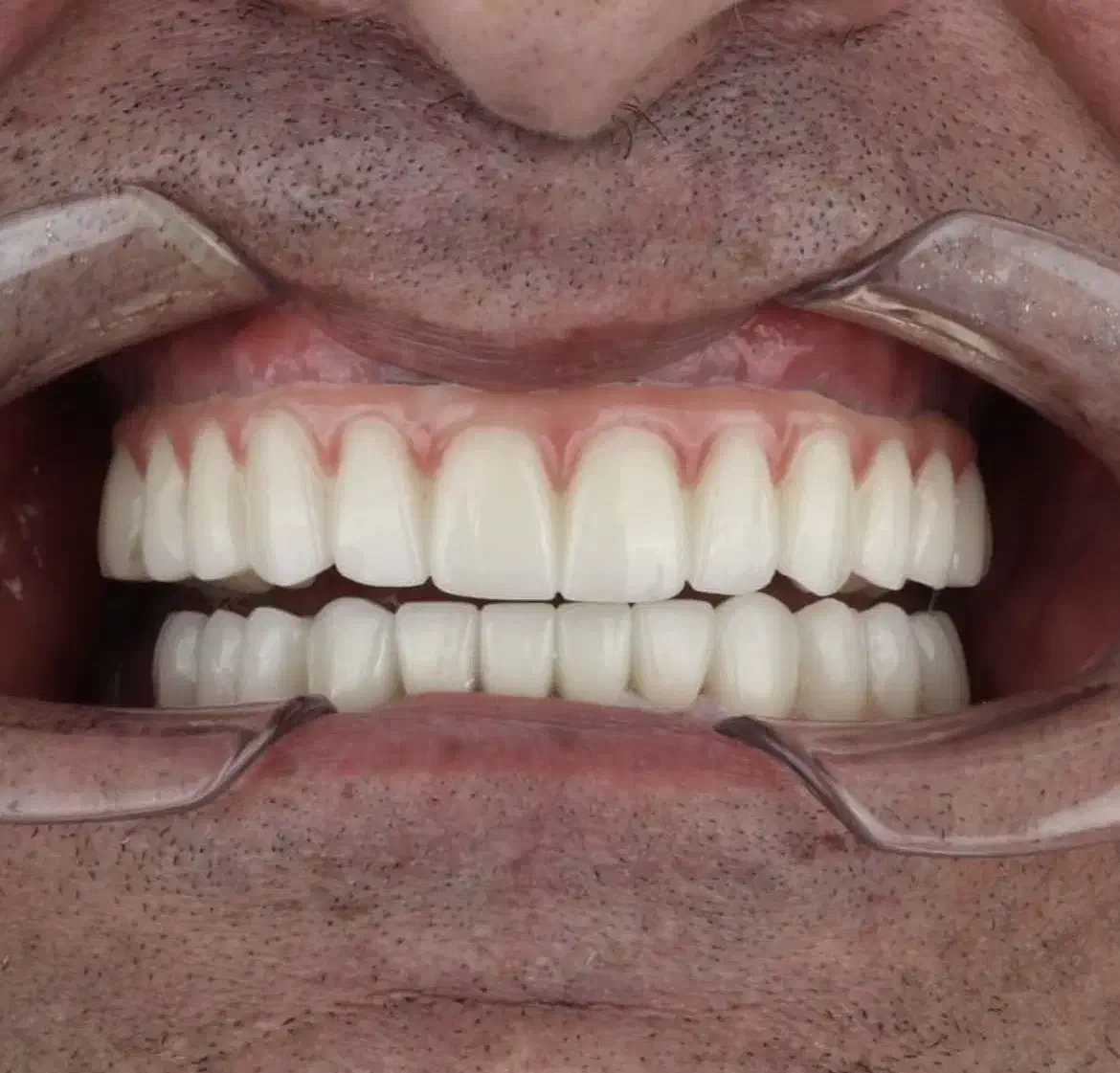 ایمپلنت،اوردنچر دو فک ۱۰۰ تومن در تبریز|خدمات آرایشگری و زیبایی|اهر, |دیوار