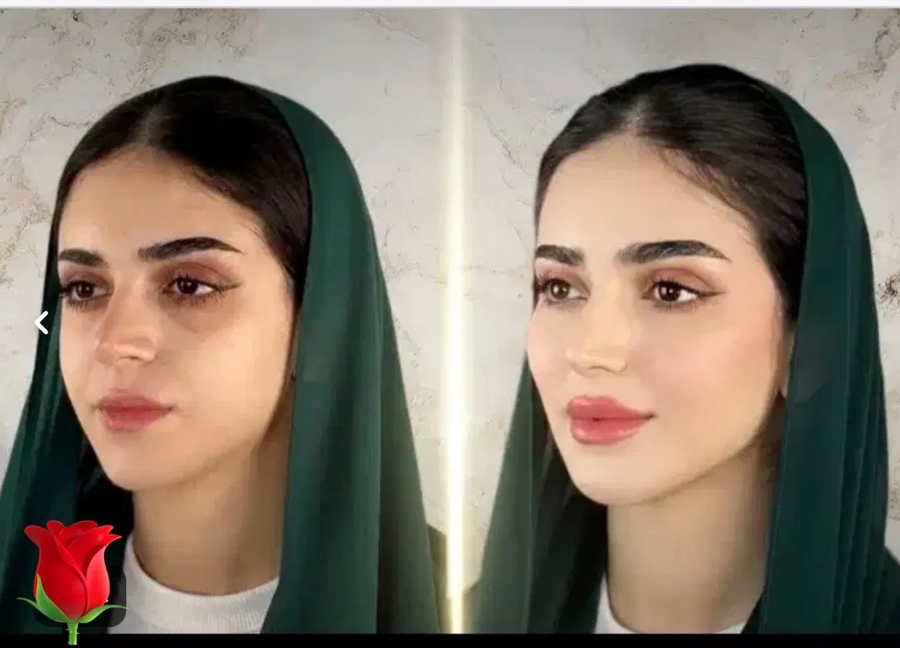 تزریق ژل بوتاکس فیلربادی باسن بیکینی هیپ دیپ لیفت|خدمات زیبایی و سلامت|تبریز, |دیوار