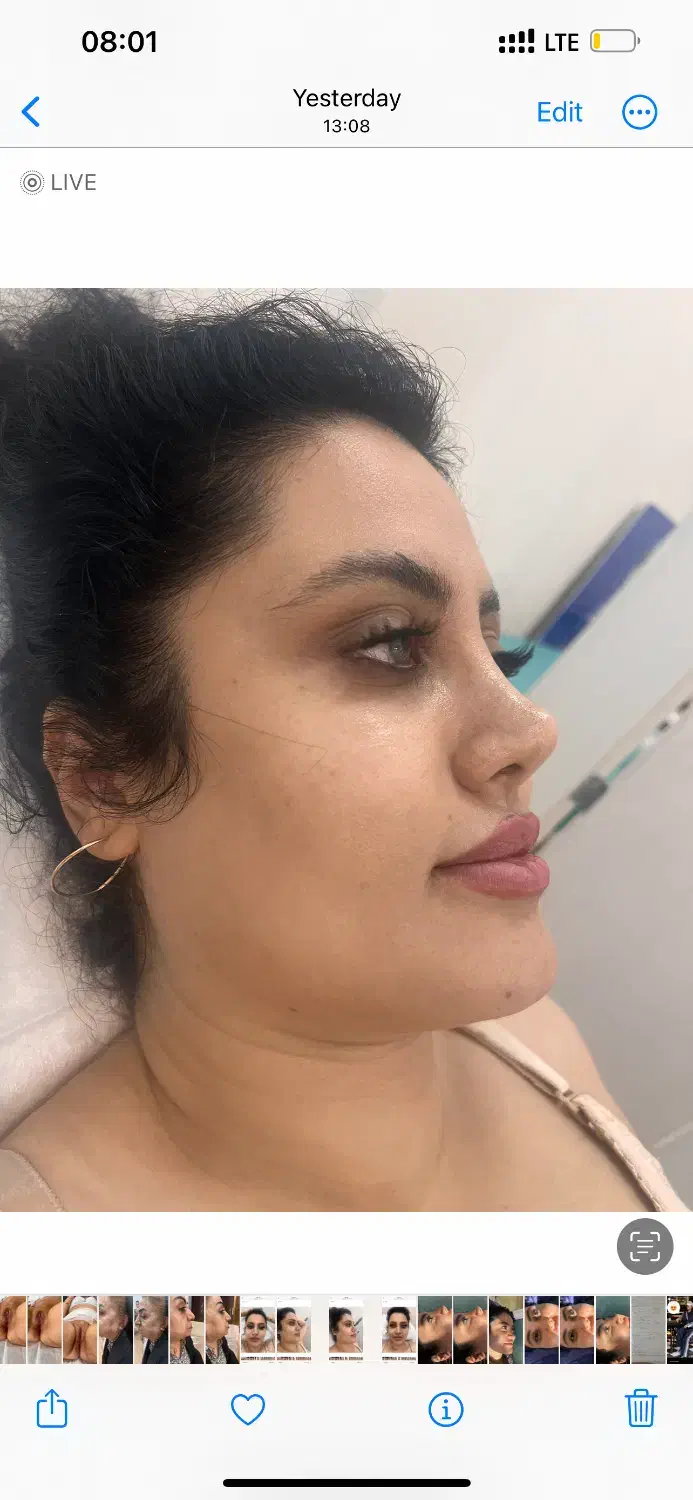 تزریق چربی به تمام نواحی|خدمات آرایشگری و زیبایی|قزوین, |دیوار