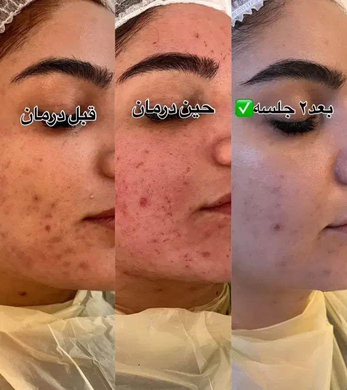 پاکسازی درمانی و تخصصی پوست برا خانم ها و آقایان|خدمات آرایشگری و زیبایی|کاشان, زیدی|دیوار