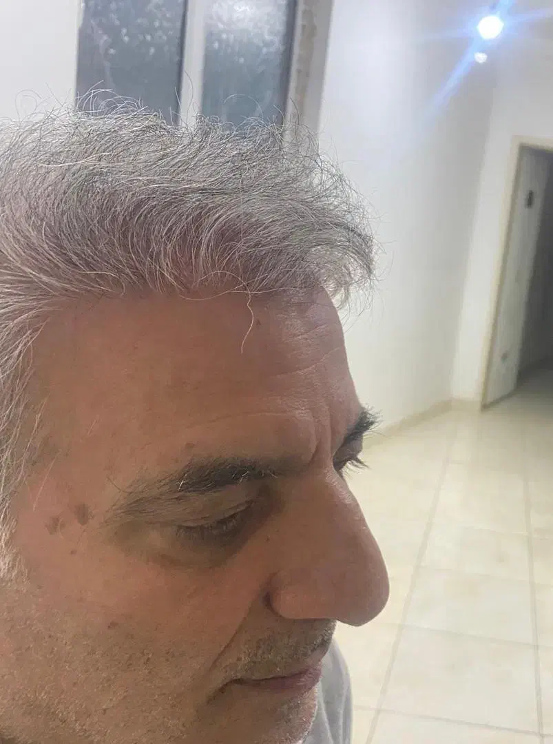 کاشت مو 12 ملیون با ضمانت|خدمات آرایشگری و زیبایی|تبریز, |دیوار