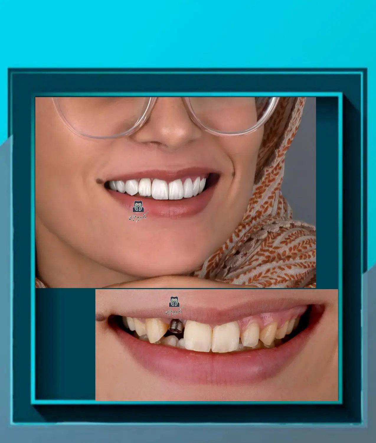 پیشنهادویژه عصبکشی دندان درپایتخت دندانپزشکی شیراز|خدمات زیبایی و سلامت|شیراز, ارم|دیوار