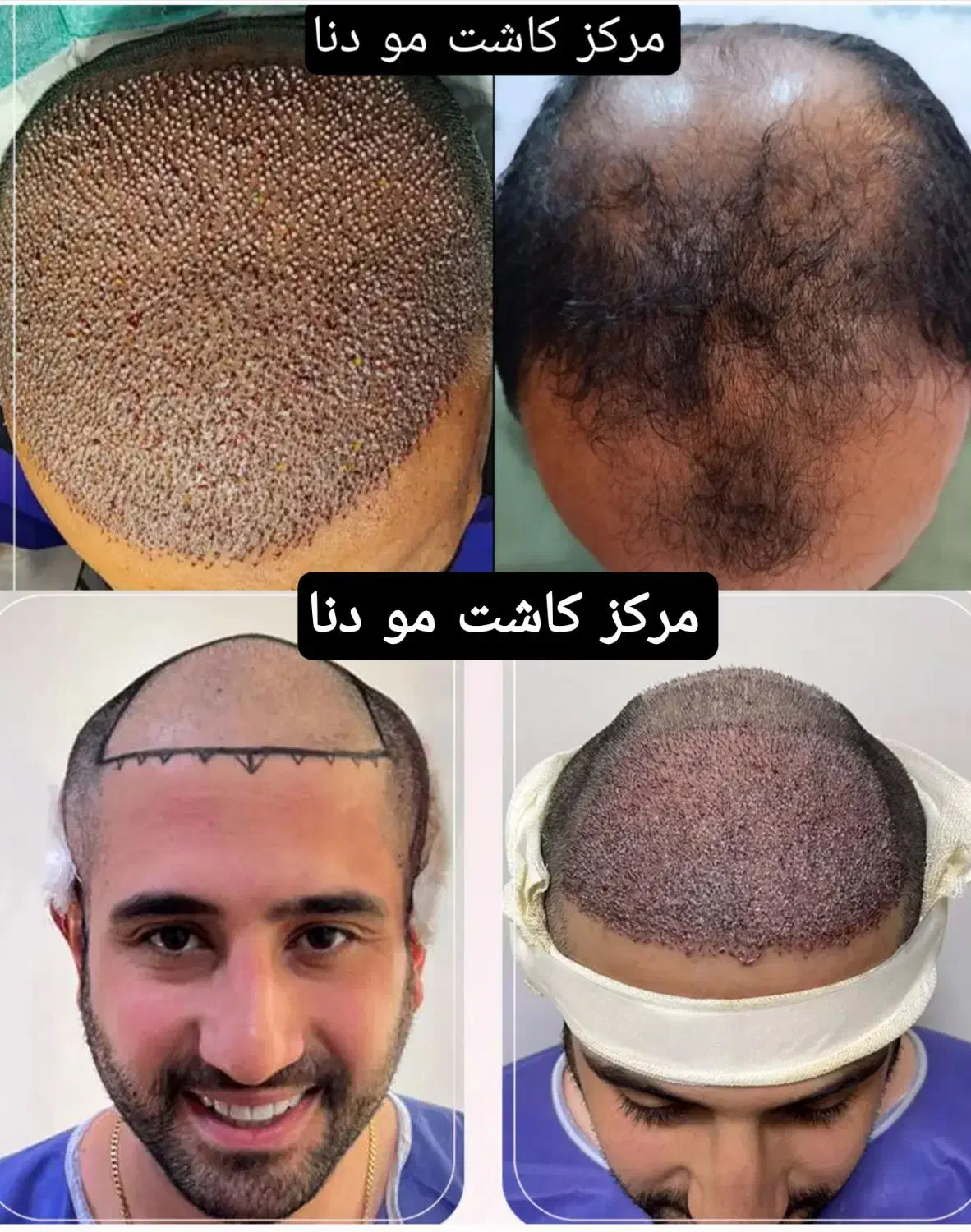 مرکزکاشت مو/ابرو دنا/تیم کاشت بین‌المللی(غیربومی)|خدمات آرایشگری و زیبایی|یاسوج, |دیوار