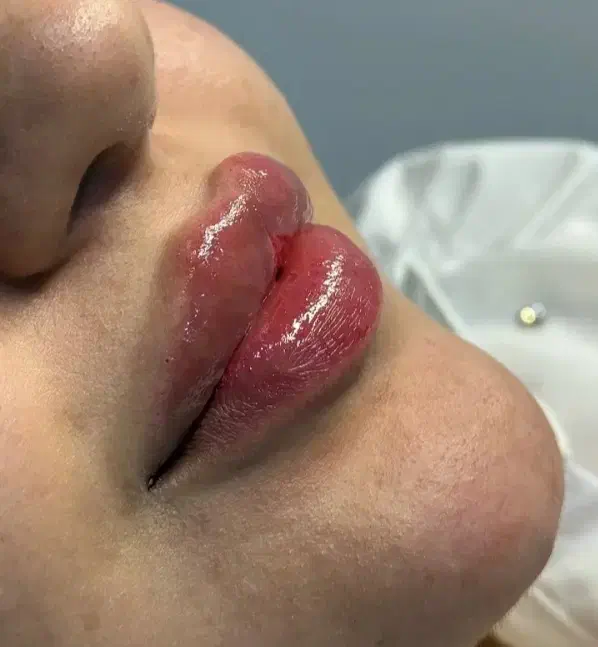 بوتاکس فیلر تخصصی و فیلر بادی و پی ارپی|خدمات آرایشگری و زیبایی|کرمانشاه, |دیوار